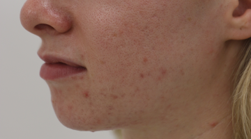 My Journey with Acne