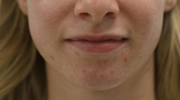 My Journey with Acne - Part Two
