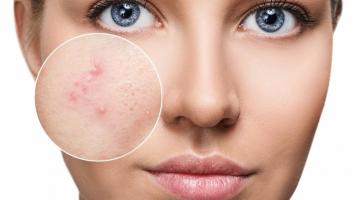 Top Ten Dos and Don'ts of Living with Acne