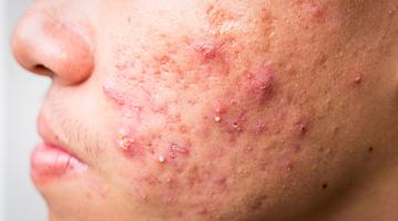 Acne: A Comprehensive Guide by Dr Rima Clayton