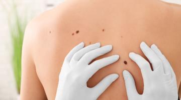 Why Should You Check Your Moles?