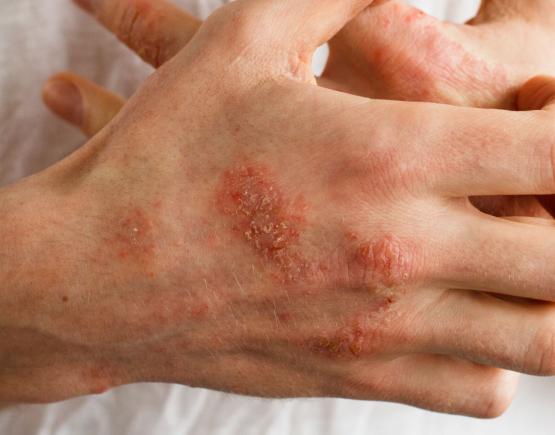 Eczema Treatment Reading Eczema Causes Symptoms And Treatments Derma